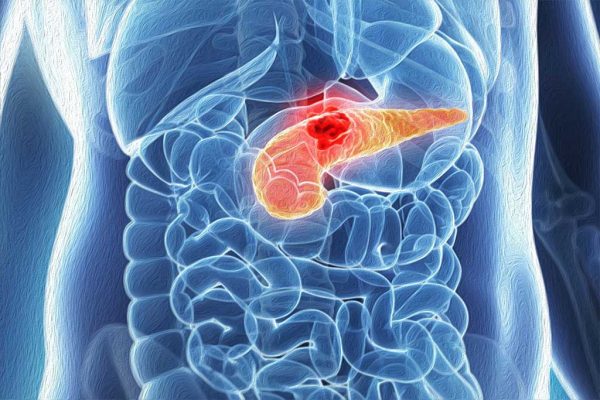 tumore al pancreas